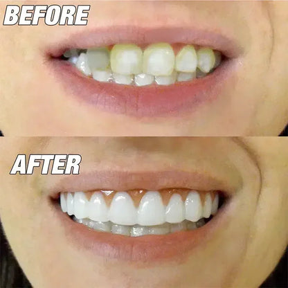 Perfect Smile Silicone Veneers *