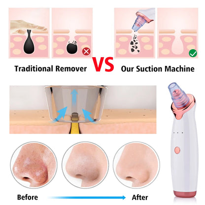 Ultimate Blackhead Vacuum Cleaner